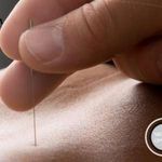 Nyon Acupuncture